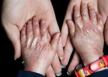 آمریکا در پرونده “تحریم کودکان پروانه‌ای” محکوم شد