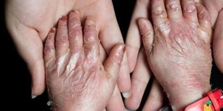 آمریکا در پرونده “تحریم کودکان پروانه‌ای” محکوم شد